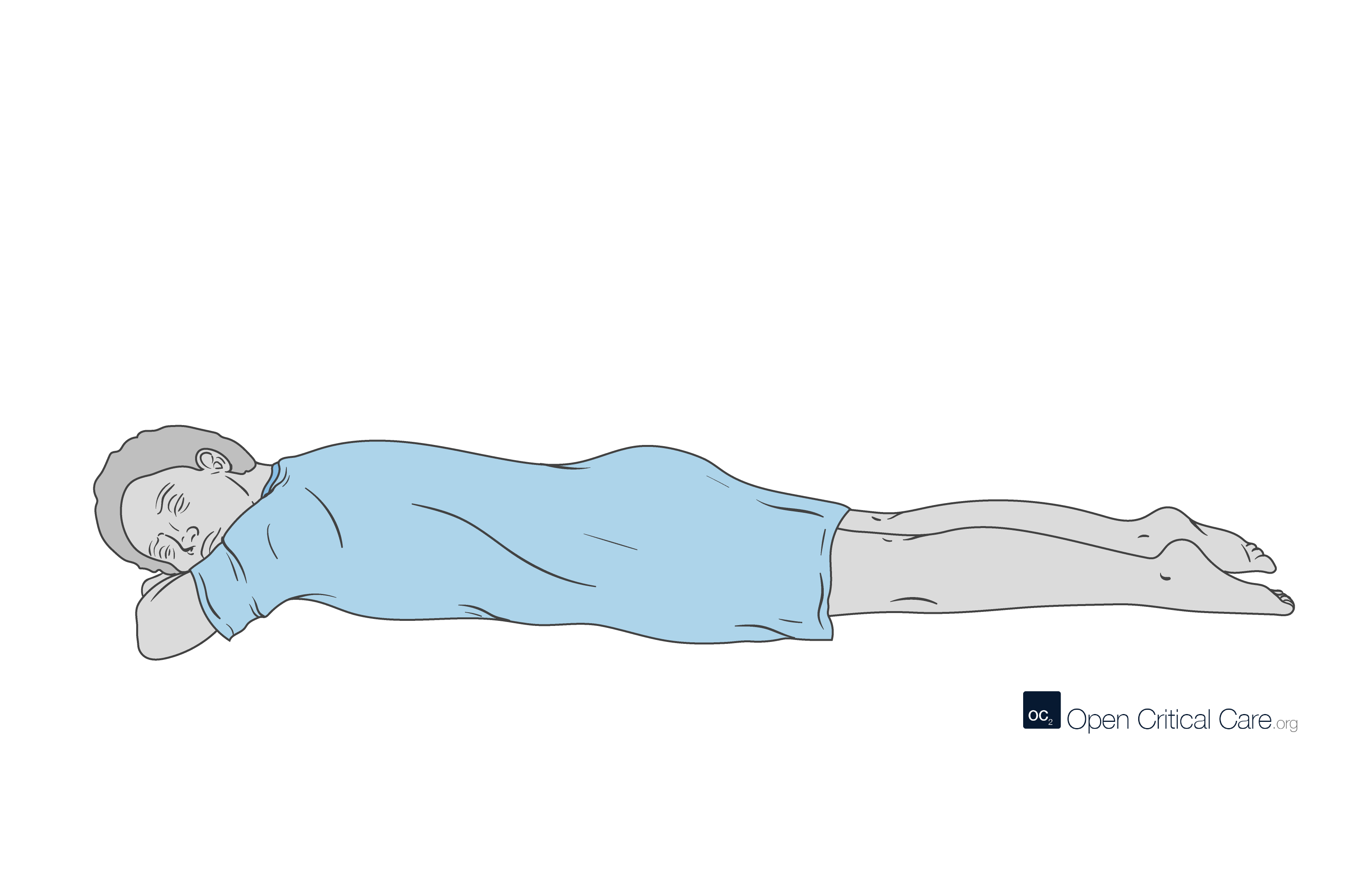 Prone positioning (side view) - Open Critical Care